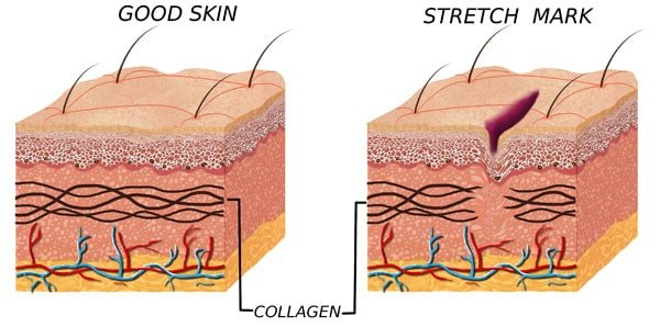 rotura de las fibras de colageno causantes de las estrias